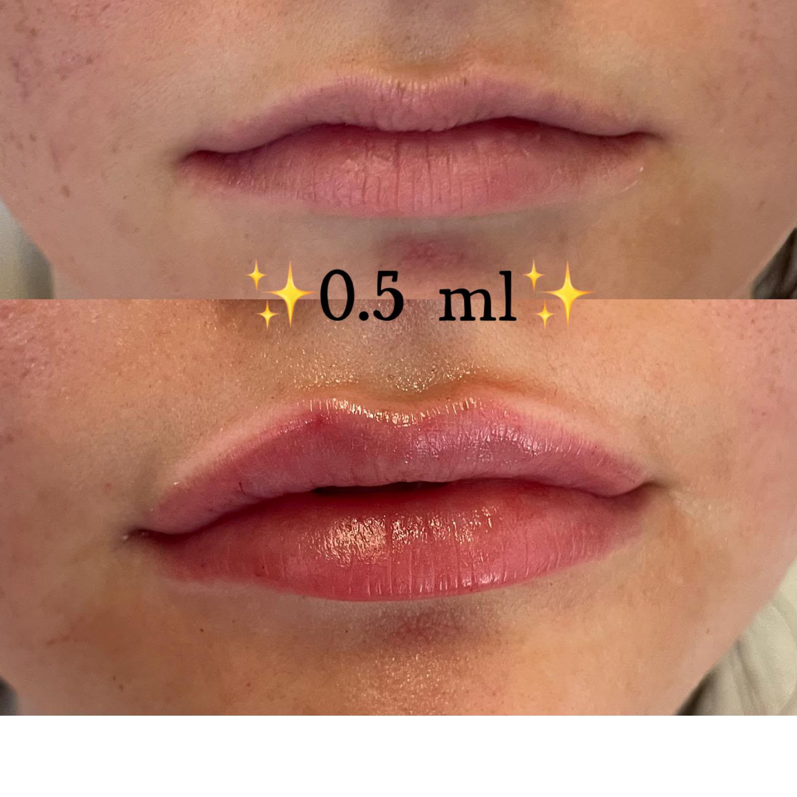 0.5ml lip filler before and after