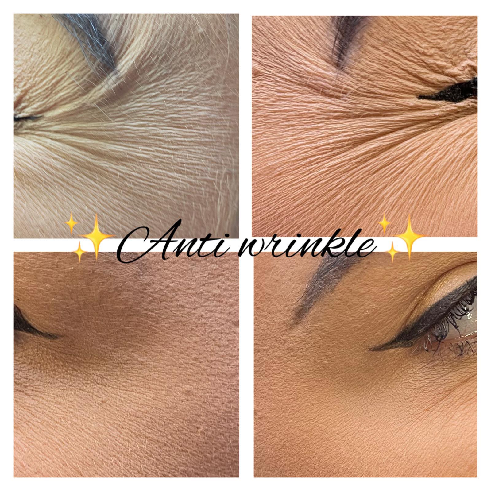 Anti-wrinkle before and after results