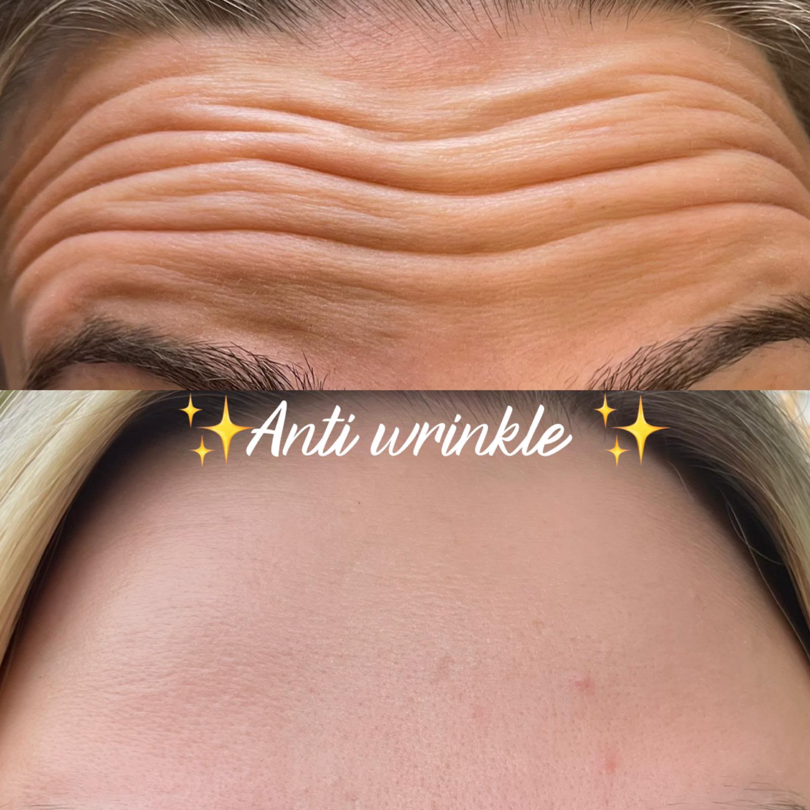 Forehead anti-wrinkle before and after